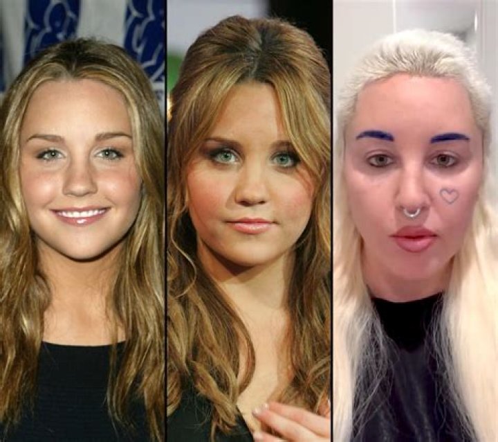 Amanda Bynes Breast Implants Plastic Surgery Before and After