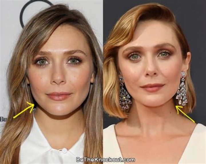 Elizabeth Olsen Plastic Surgery Before and After