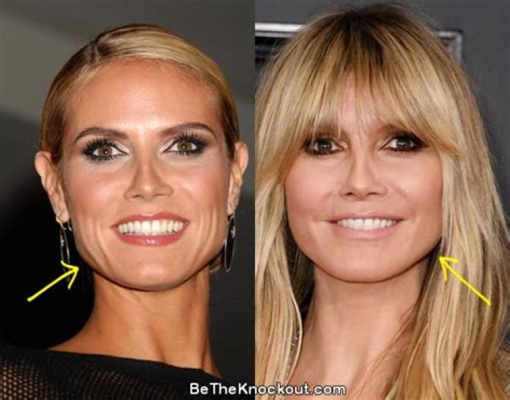 Heidi Klum Plastic Surgery: Klum's Revert to The Recent Speculations and Her Special Skincare Secrets!