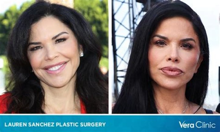 Lauren Sanchez Plastic Surgery: From Nose Job to Facelift Everything We Know!