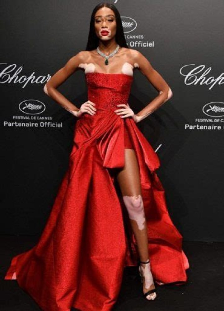 Winnie Harlow Measurements Height Weight Bra Size Body Stats Facts